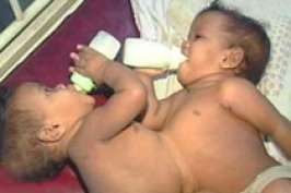 В Индии разделили 10-месячных сиамских близнецов